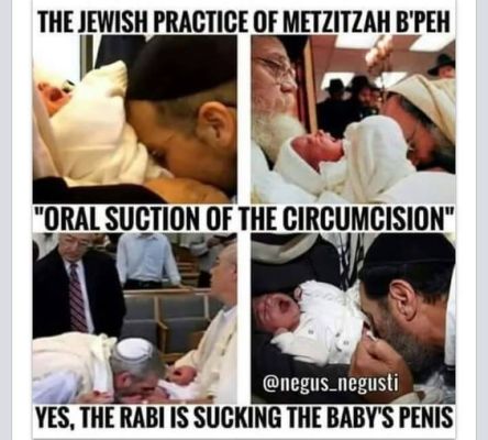 Resultado de imagem para rabbi new york circumcision herpes